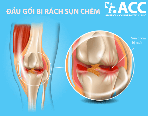 11 loại chấn thương đầu gối thường gặp và cách điều trị